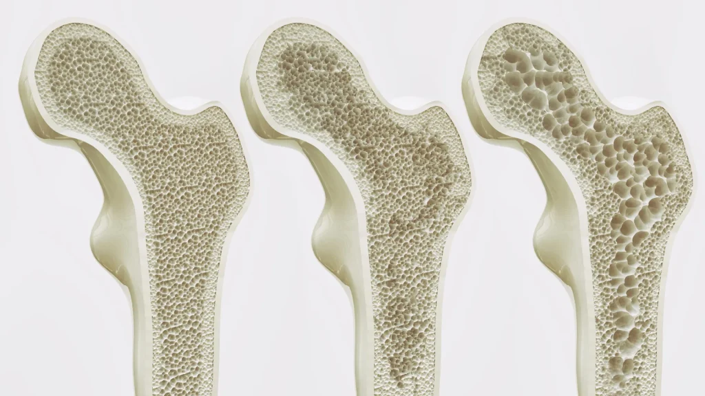 Many people take calcium and vitamin D for strong bones, but a large review shows minimal advantages.