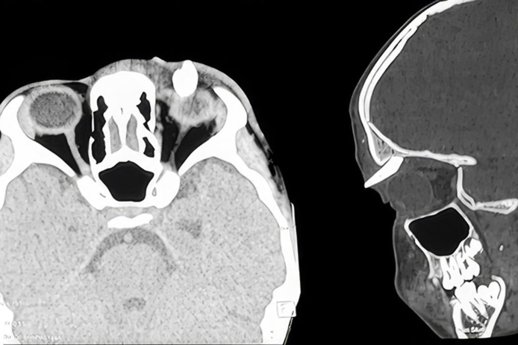 Teen becomes the 'first' patient to have a tooth growing in an unusual location