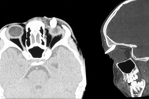 Teen becomes the 'first' patient to have a tooth growing in an unusual location