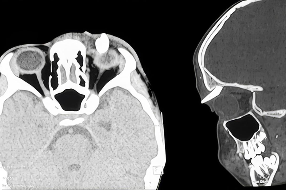 Teen becomes the 'first' patient to have a tooth growing in an unusual location