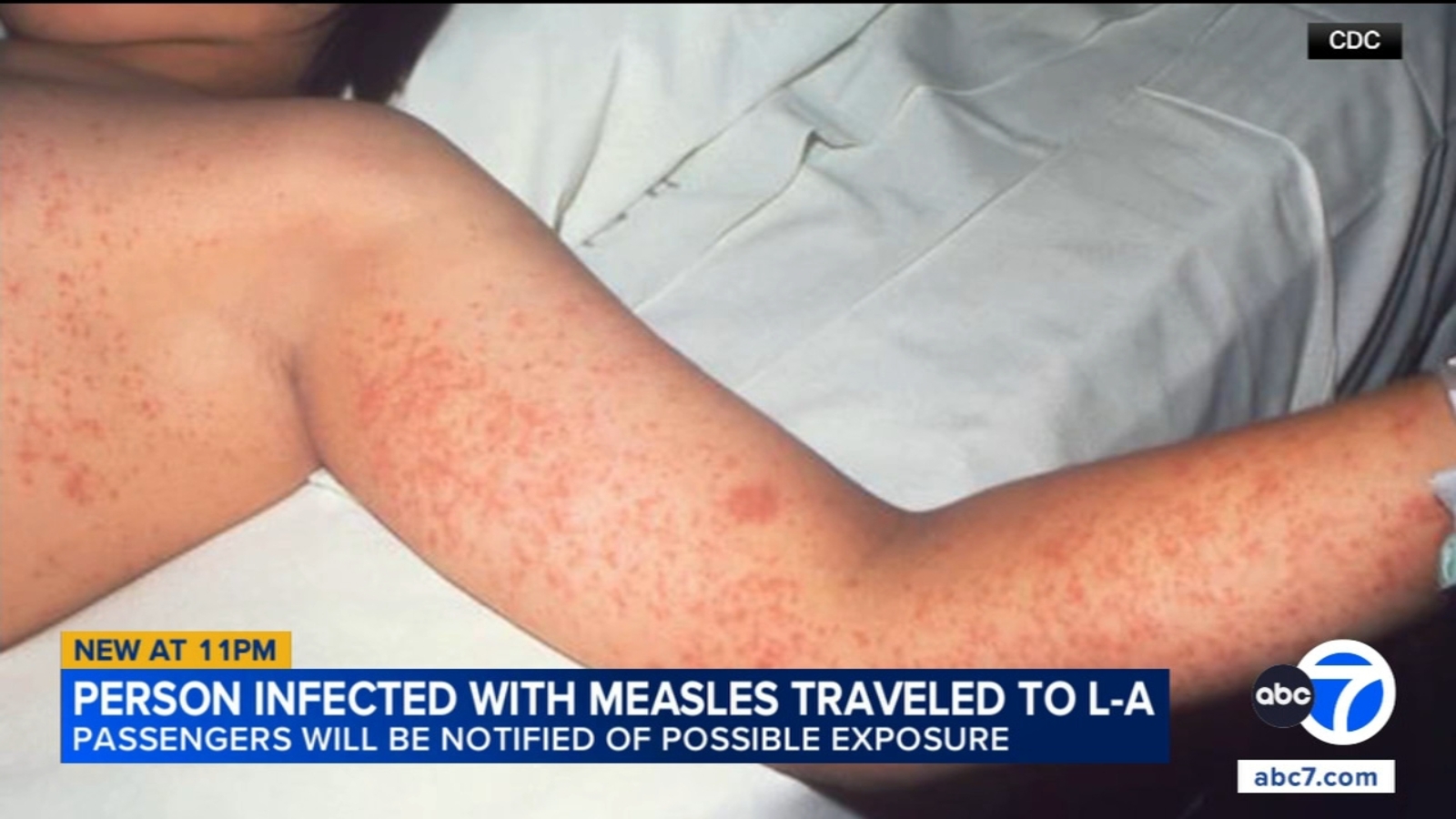 Travelers at LA Union Station might have been exposed to measles by an infected individual, health officials cautioned.