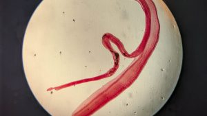 Woman's brain worm infection verified after eggs develop tails in laboratory examination