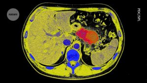 Can pancreatic cancer be halted? A bold approach brings optimism
