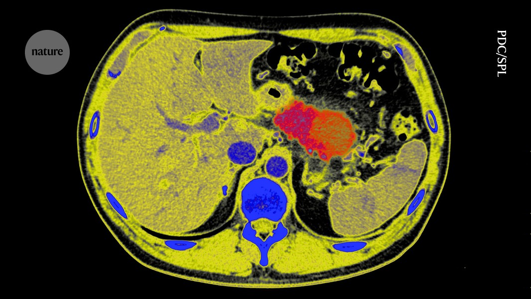 Can pancreatic cancer be halted? A bold approach brings optimism