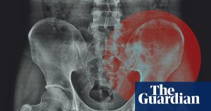 Do we actually store tension in our hips?
