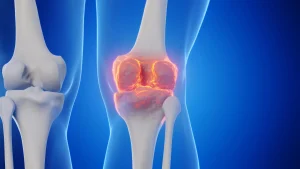 Farewell to joint replacements? Researchers at Stanford discovered a method to regenerate cartilage and prevent arthritis.