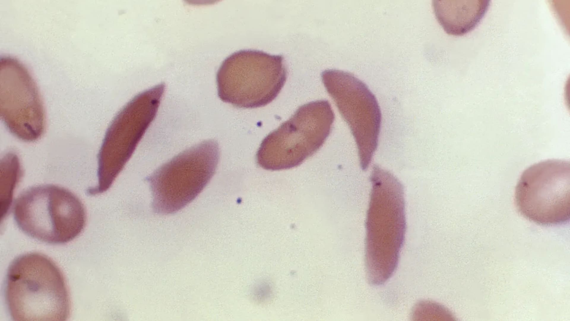 Gene therapies for sickle cell disease provide new promise, but access is challenging.