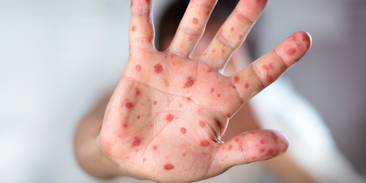 Measles case identified in Huntsville