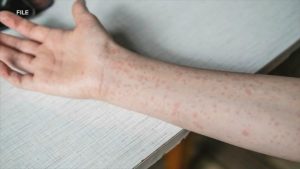 Oxford Area High School shut down on Friday due to a confirmed measles case.