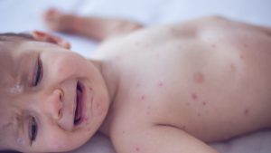 Pennsylvania warns about congenital measles&mdash;an occurrence not seen in the US for many years.