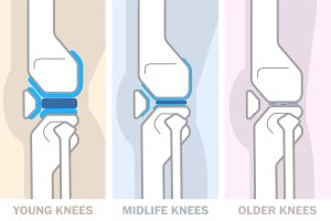 Ways to look after your knees in your 20s, 30s, 40s and later